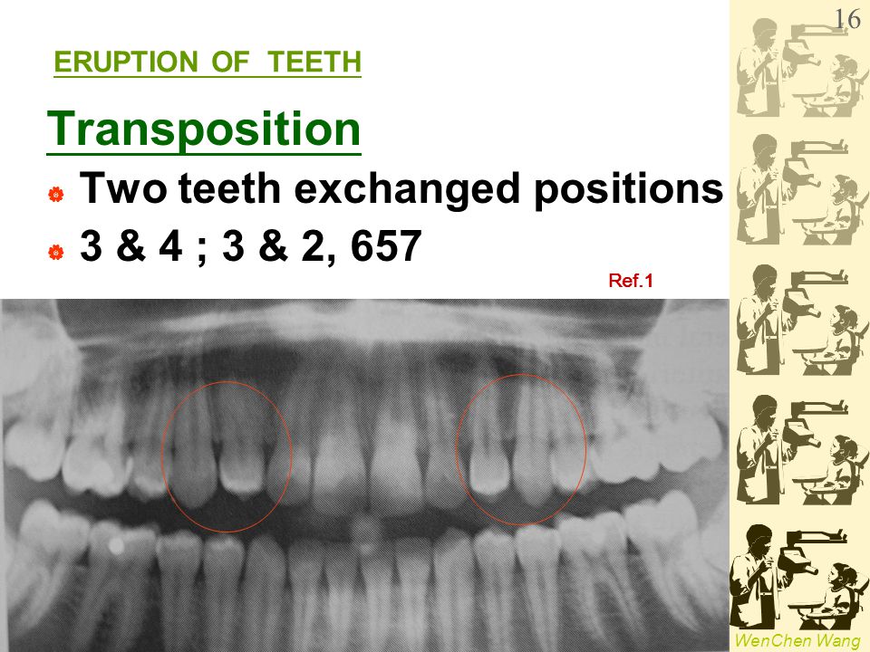 Transposition Two teeth exchanged positions 3 & 4 ; 3 & 2, 657