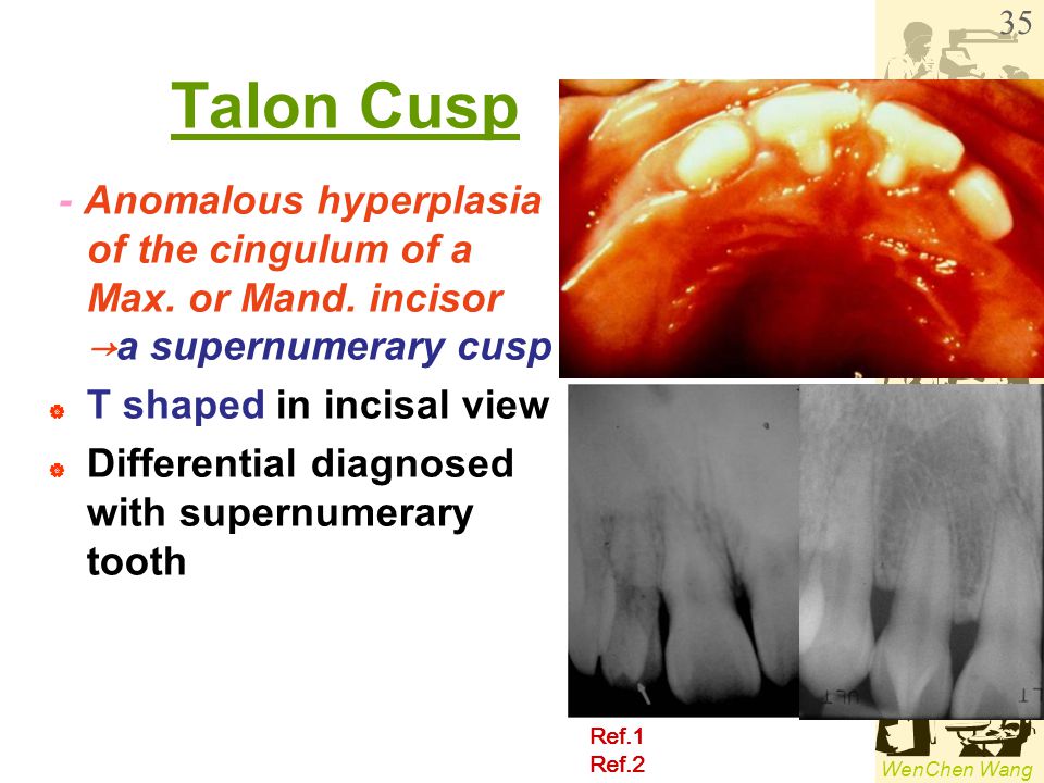 Talon Cusp - Anomalous hyperplasia of the cingulum of a Max. or Mand. incisor →a supernumerary cusp.