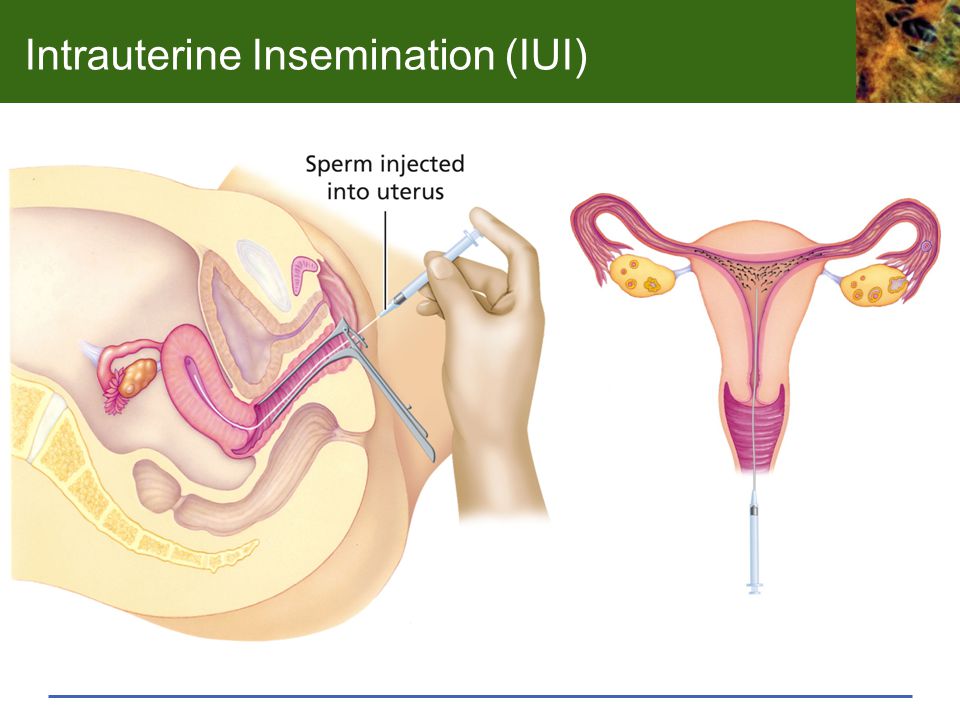 Why wont sperm attach to uterus