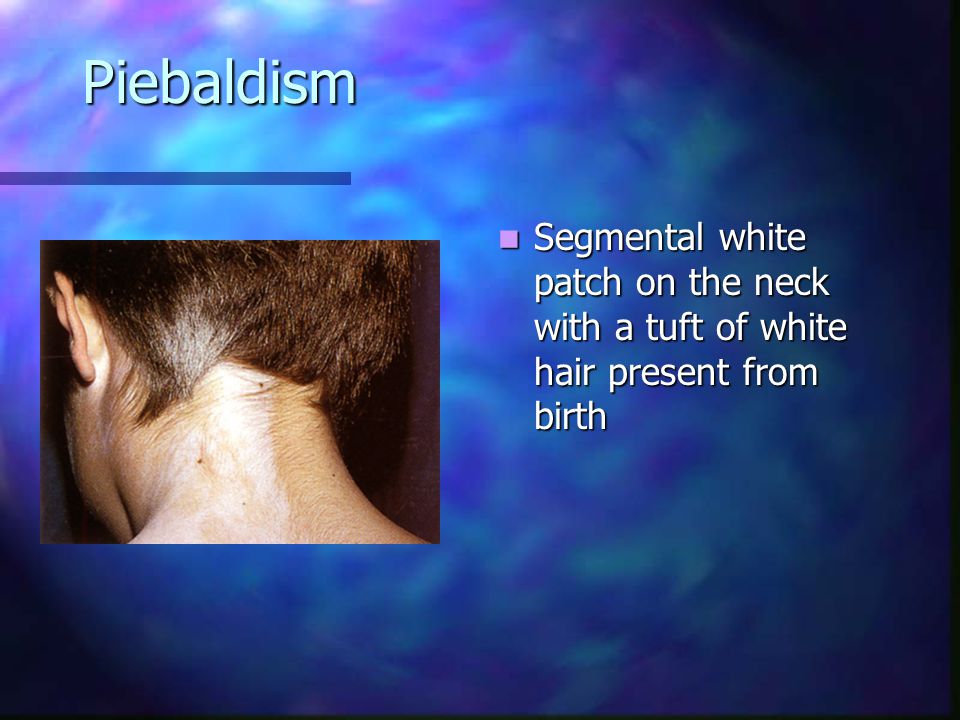 Piebaldism Segmental white patch on the neck with a tuft of white hair present from birth