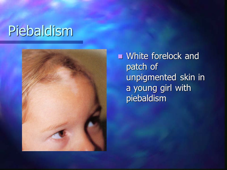 Piebaldism White forelock and patch of unpigmented skin in a young girl with piebaldism