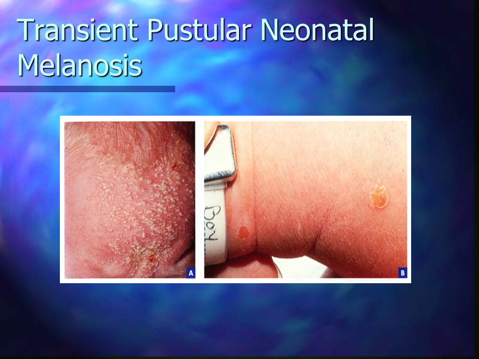 Transient Pustular Neonatal Melanosis