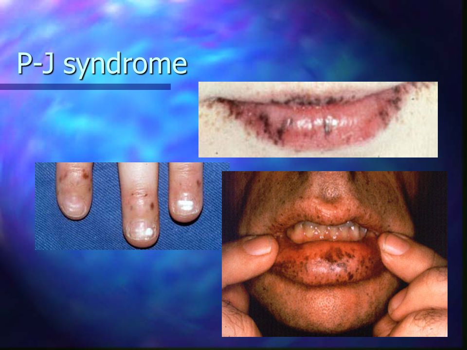 P-J syndrome