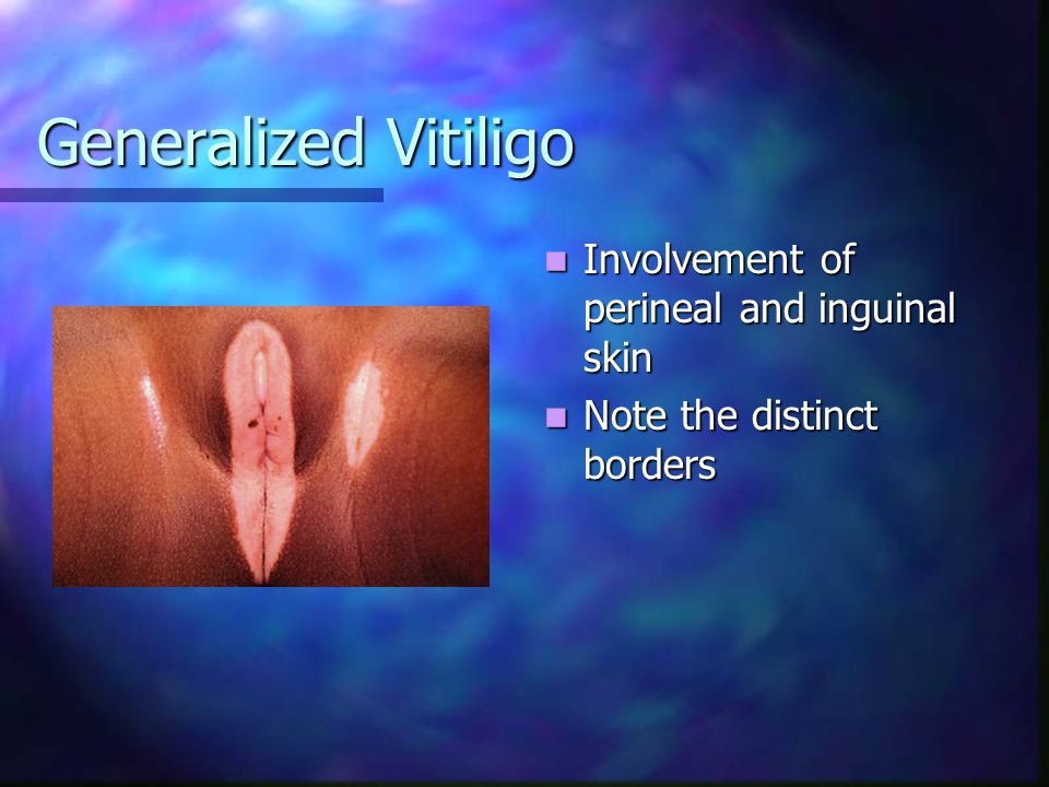 Generalized Vitiligo Involvement of perineal and inguinal skin