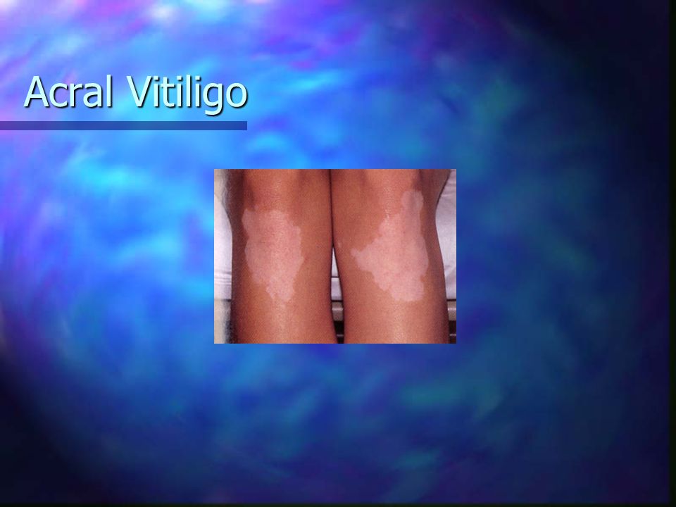 Acral Vitiligo