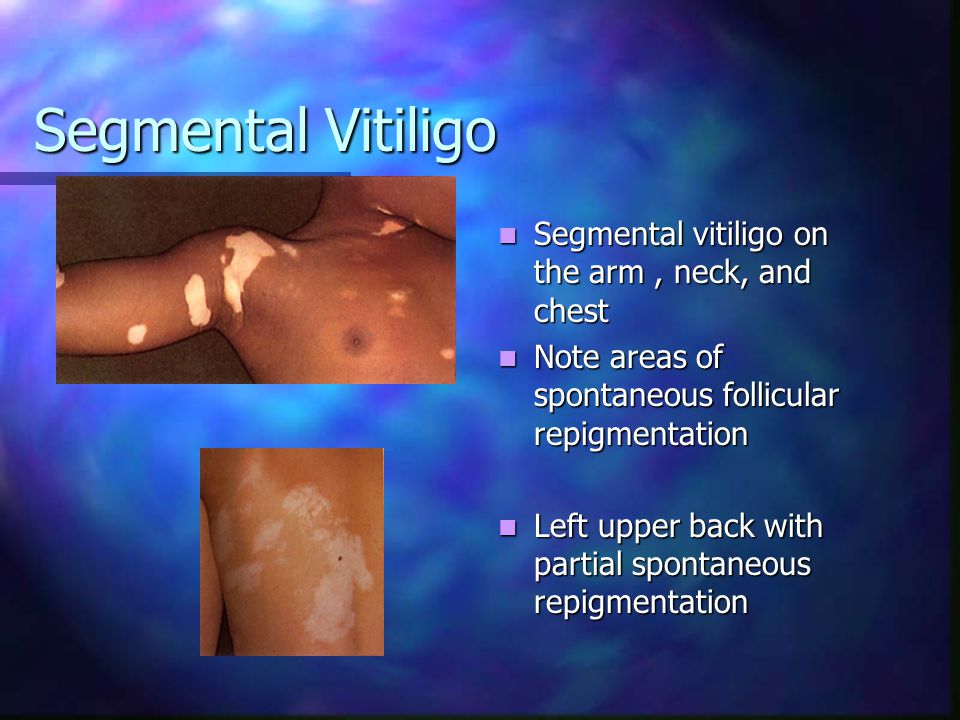 Segmental Vitiligo Segmental vitiligo on the arm , neck, and chest