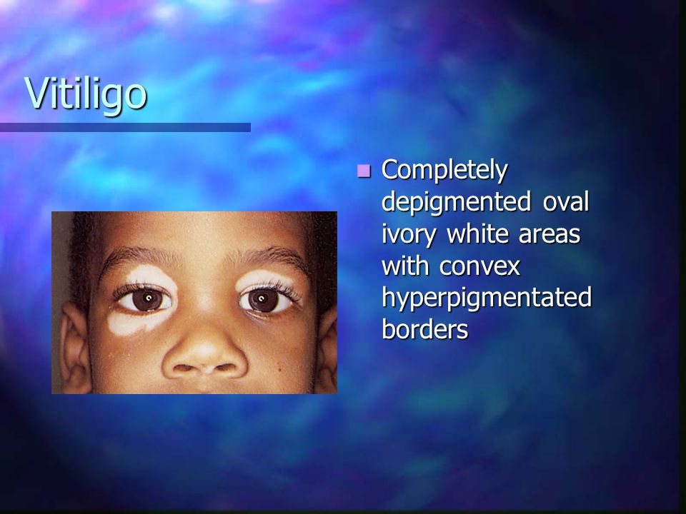 Vitiligo Completely depigmented oval ivory white areas with convex hyperpigmentated borders