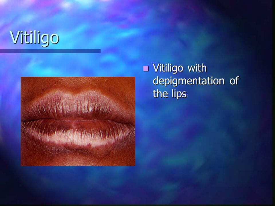 Vitiligo Vitiligo with depigmentation of the lips