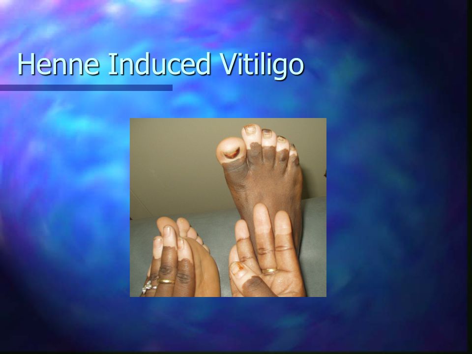 Henne Induced Vitiligo