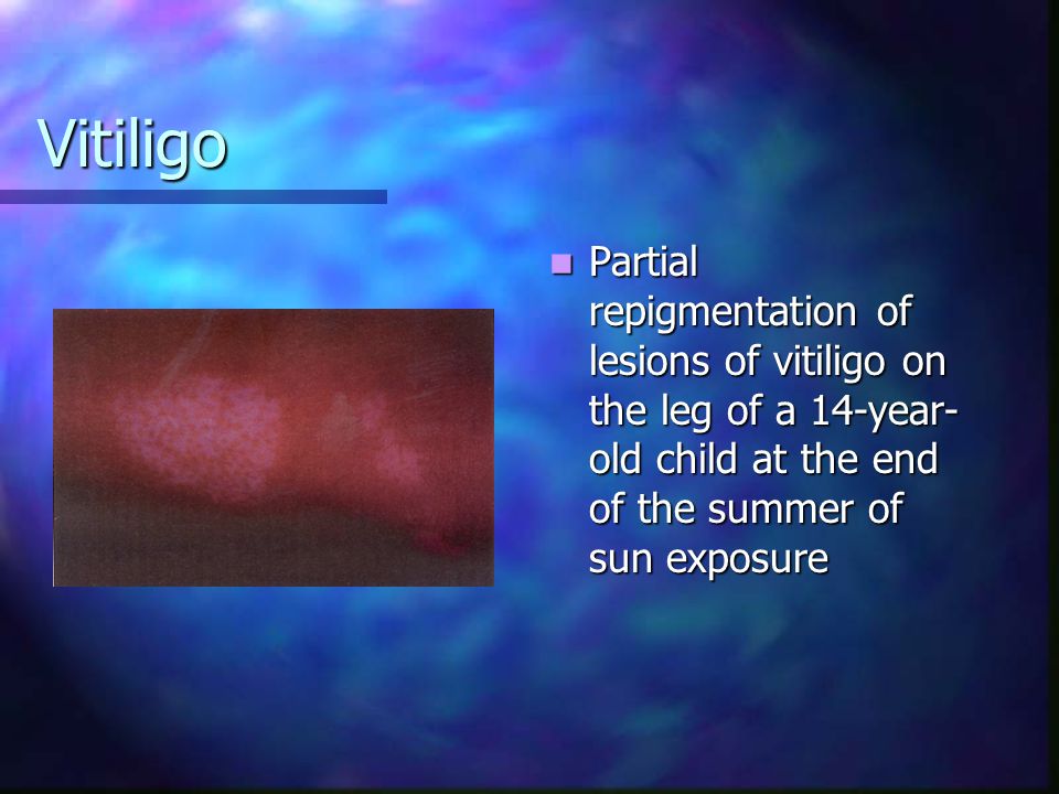 Vitiligo Partial repigmentation of lesions of vitiligo on the leg of a 14-year-old child at the end of the summer of sun exposure.