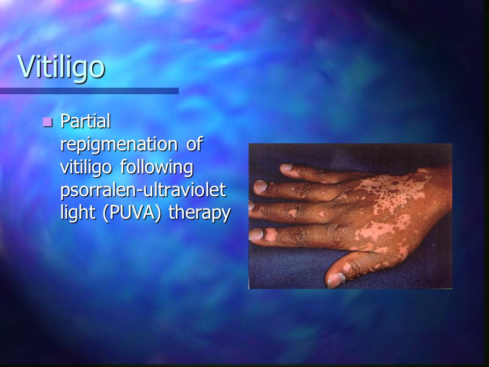 Vitiligo Partial repigmenation of vitiligo following psorralen-ultraviolet light (PUVA) therapy