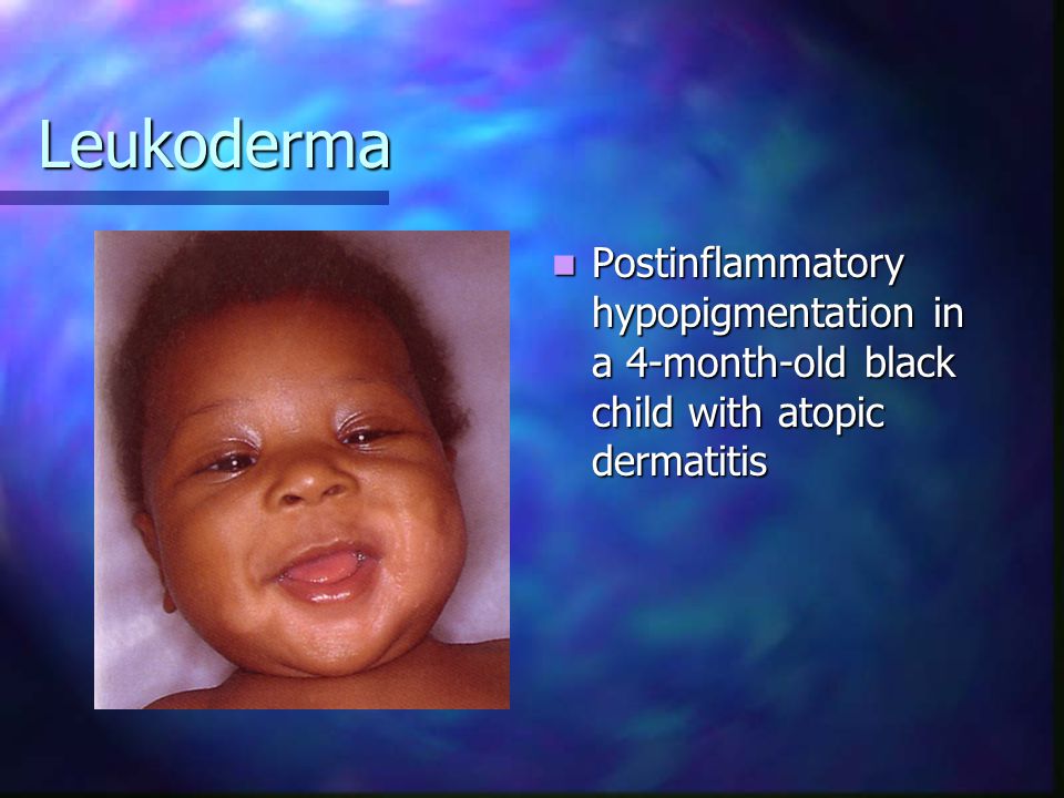 Leukoderma Postinflammatory hypopigmentation in a 4-month-old black child with atopic dermatitis