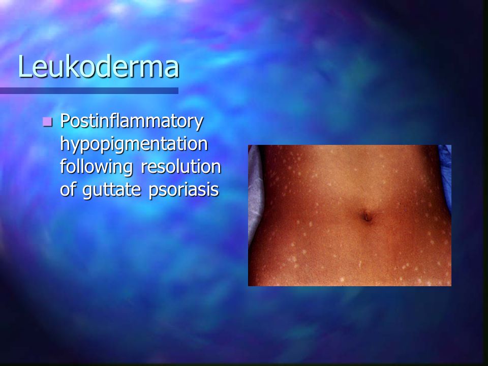 Leukoderma Postinflammatory hypopigmentation following resolution of guttate psoriasis