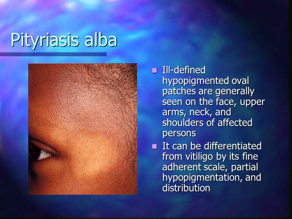 Pityriasis alba Ill-defined hypopigmented oval patches are generally seen on the face, upper arms, neck, and shoulders of affected persons.