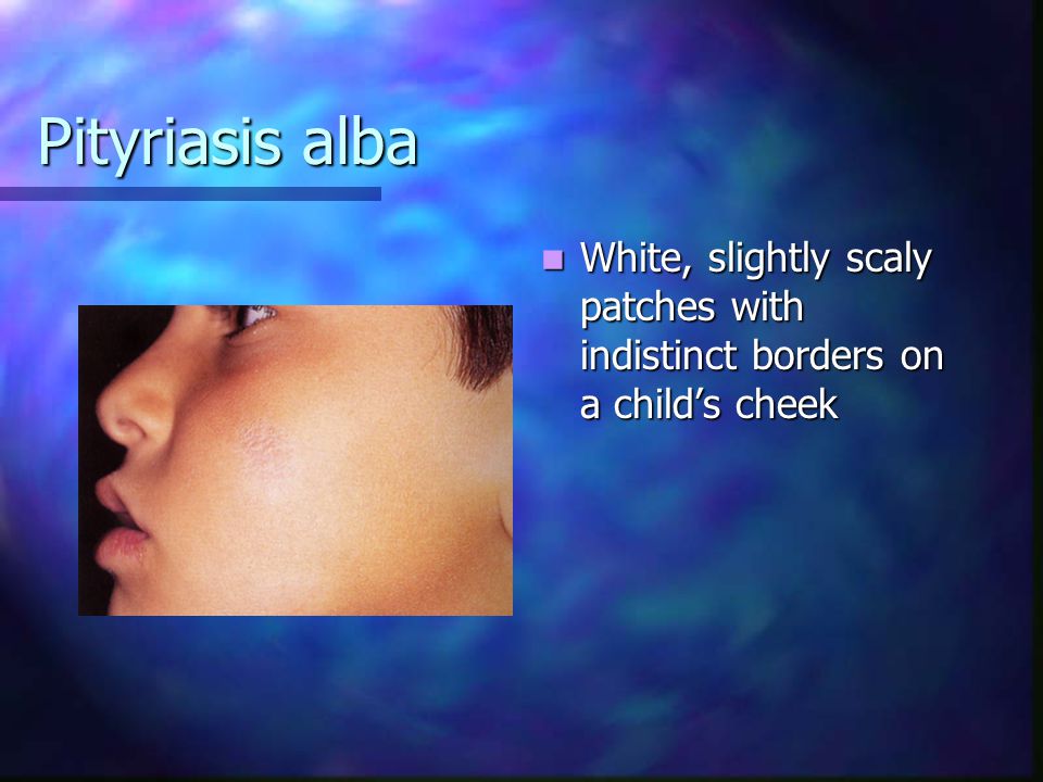 Pityriasis alba White, slightly scaly patches with indistinct borders on a child’s cheek