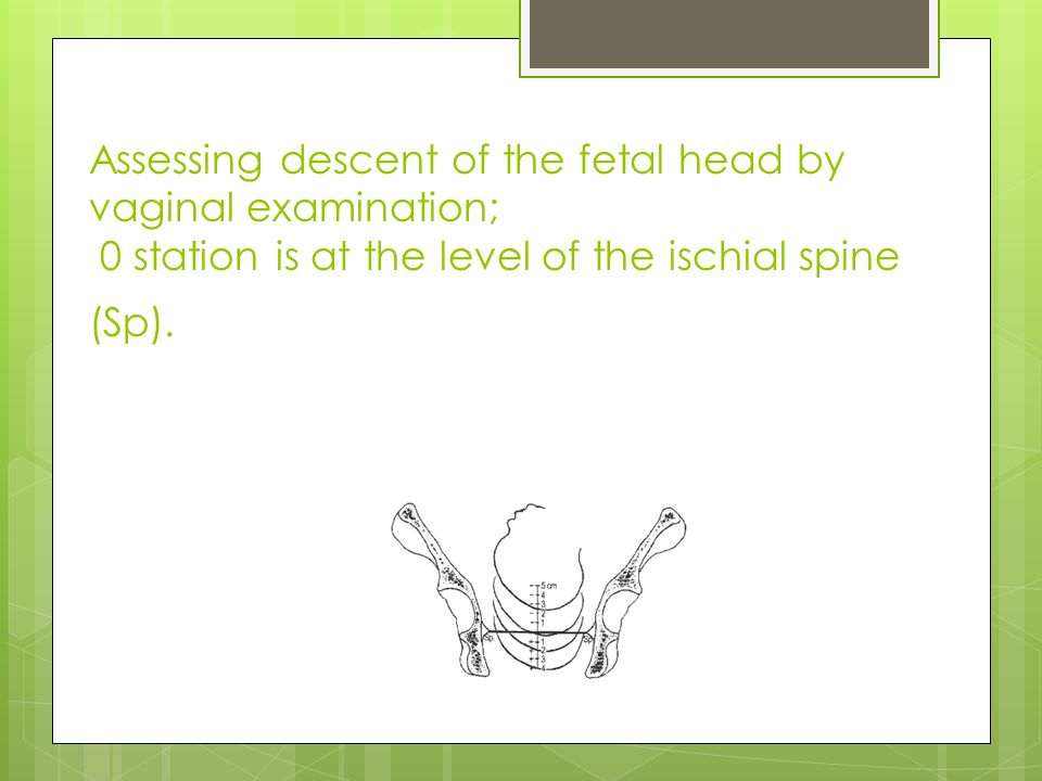 Assessing descent of the fetal head by vaginal examination; 0 station is at the level of the ischial spine (Sp).