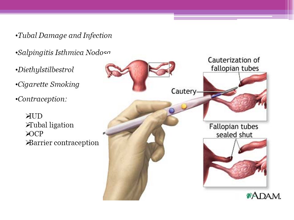 Impact of reversal of vasectomy in sperm