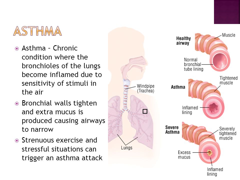 Asthma Asthma – Chronic condition where the bronchioles of the lungs become inflamed due to sensitivity of stimuli in the air.