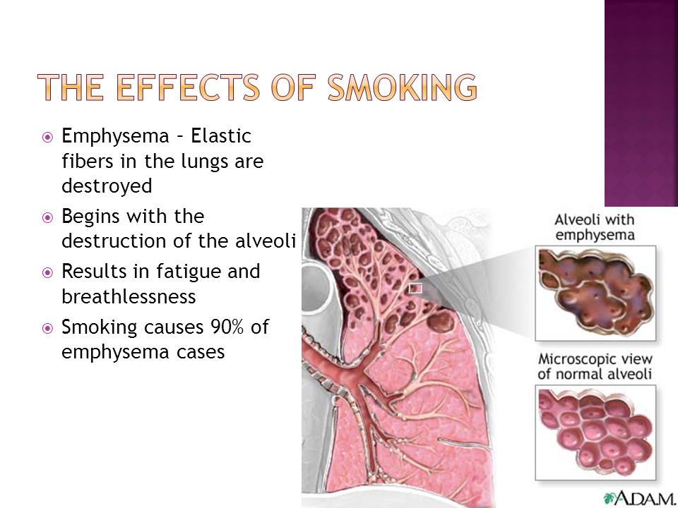 The effects of smoking Emphysema – Elastic fibers in the lungs are destroyed. Begins with the destruction of the alveoli.