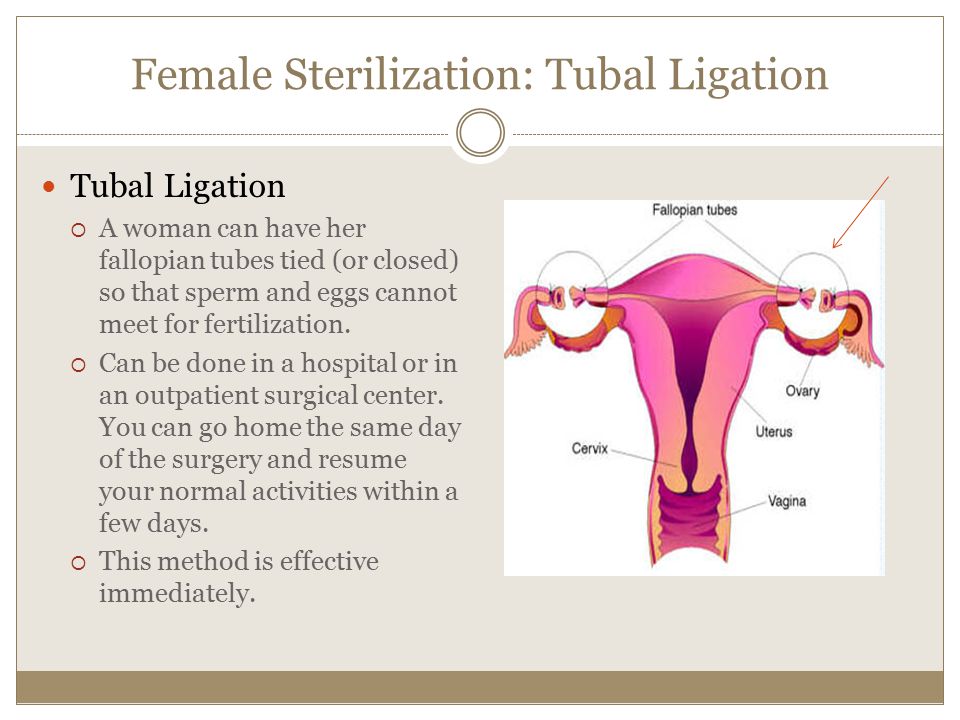Female Sterilization: Tubal Ligation