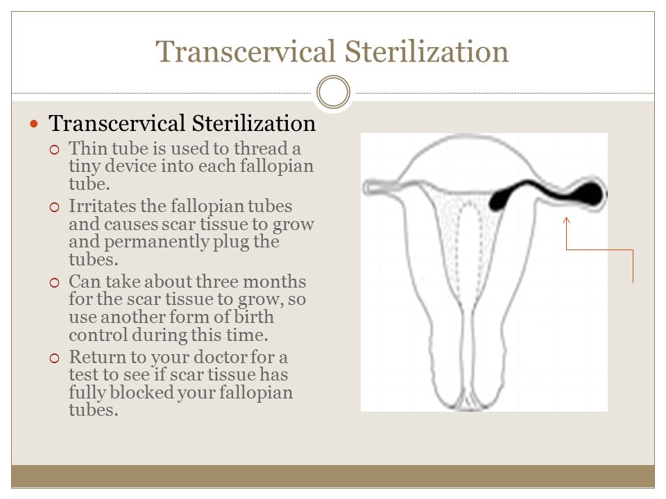 Transcervical Sterilization