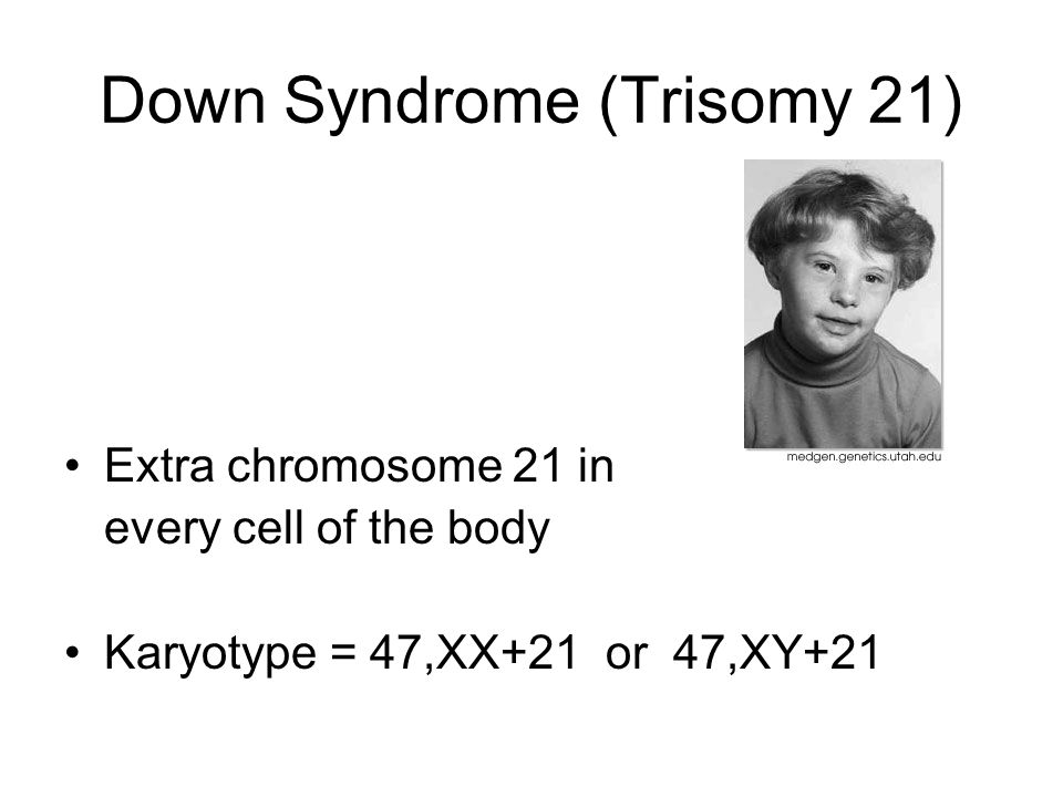 Down Syndrome (Trisomy 21)