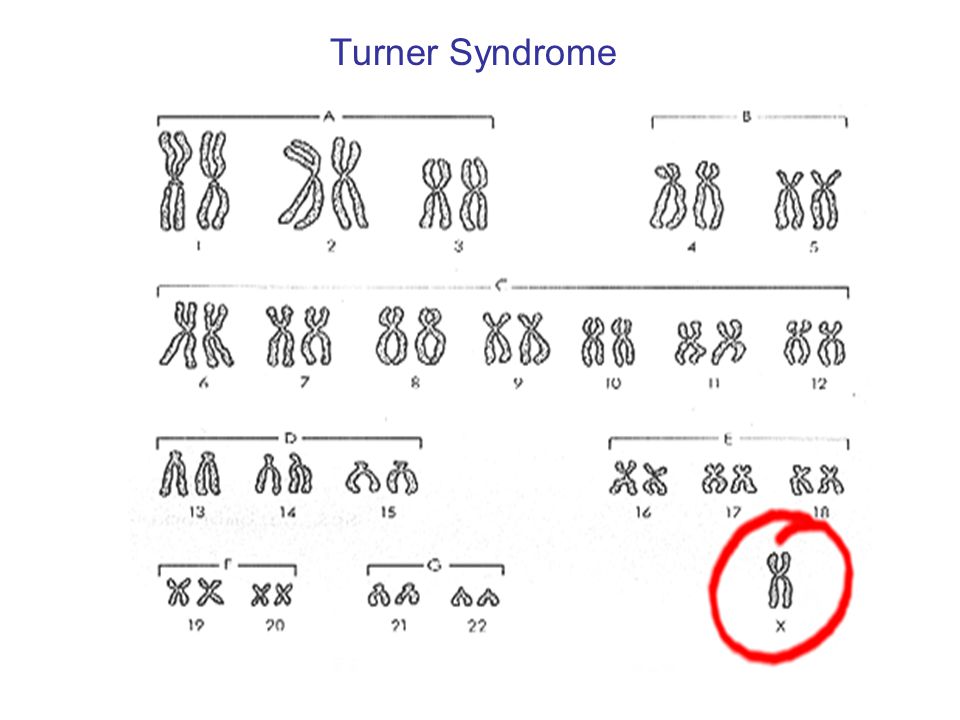 Turner Syndrome