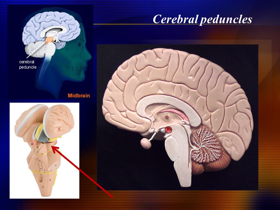 Cerebral peduncles