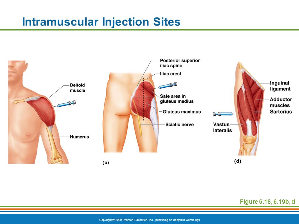 Intramuscular Injection Sites