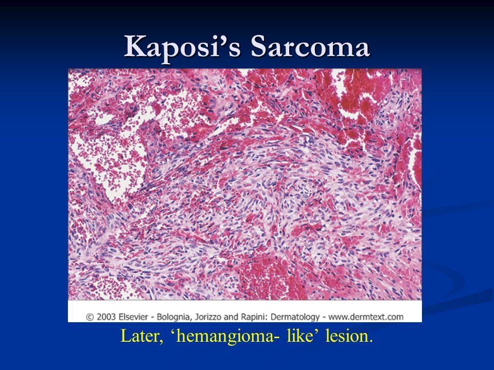 Kaposi’s Sarcoma Later, ‘hemangioma- like’ lesion.