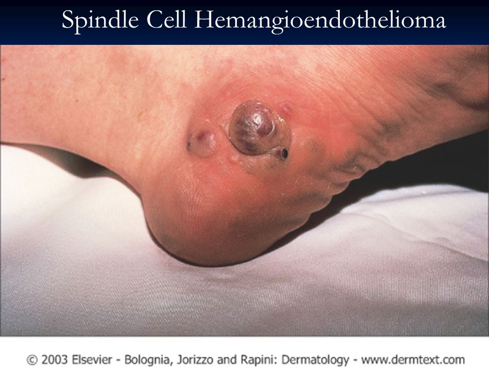 Spindle Cell Hemangioendothelioma