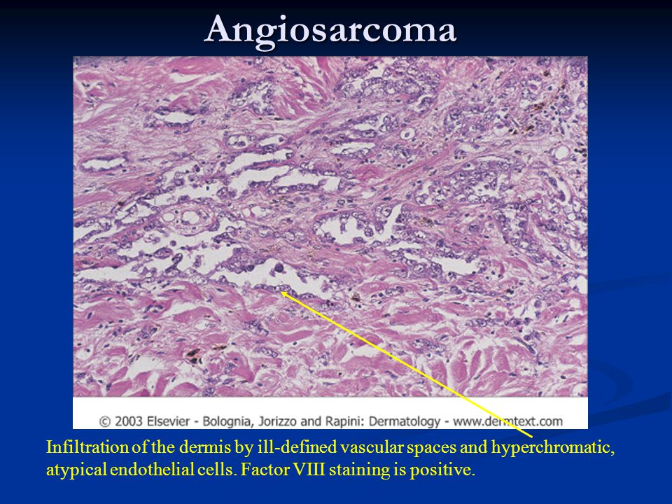 Angiosarcoma