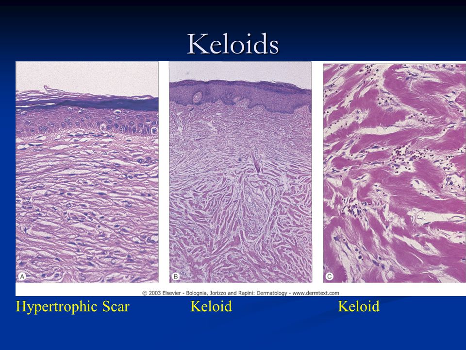 Keloids Hypertrophic Scar Keloid Keloid