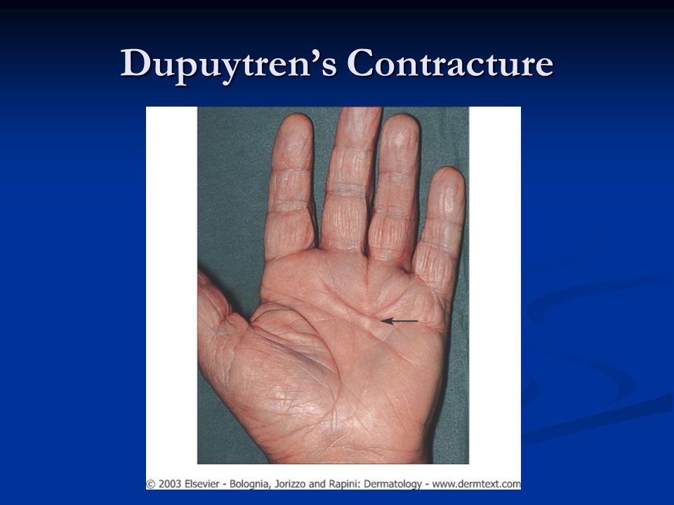 Dupuytren’s Contracture