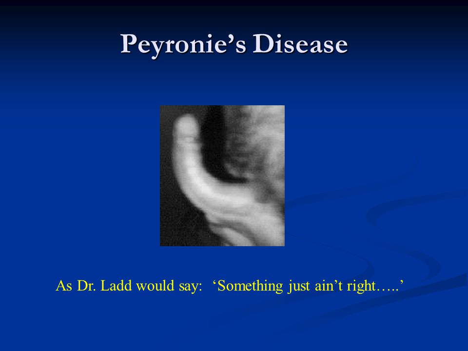 Peyronie’s Disease As Dr. Ladd would say: ‘Something just ain’t right…..’