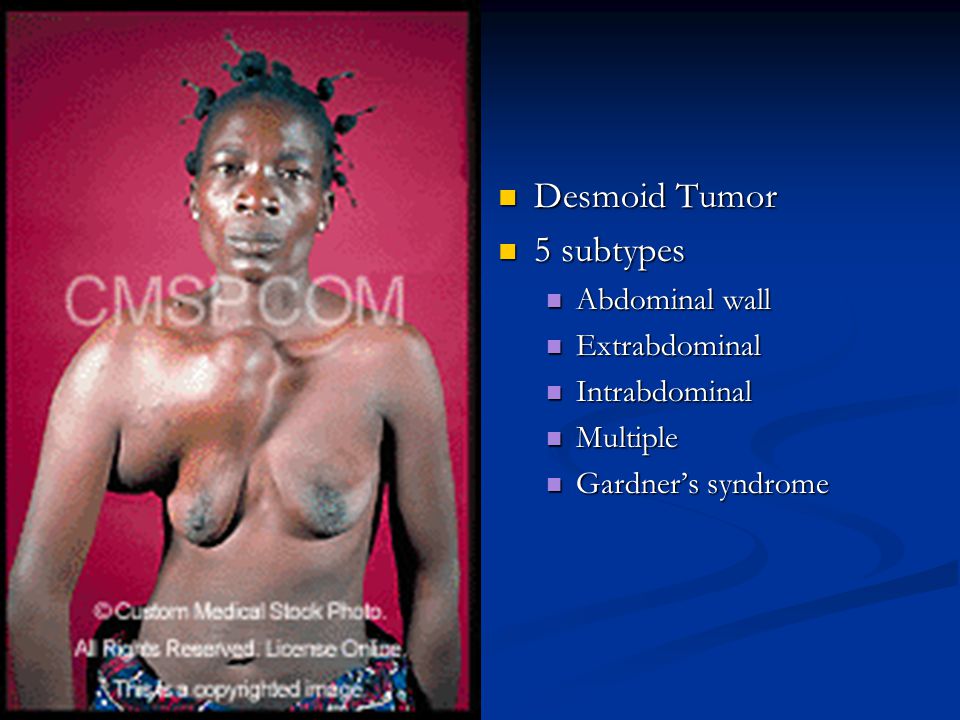 Desmoid Tumor 5 subtypes Abdominal wall Extrabdominal Intrabdominal