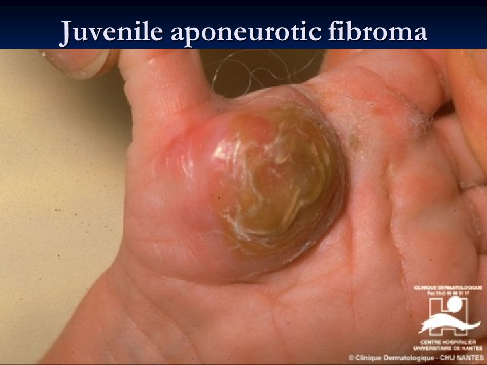 Juvenile aponeurotic fibroma