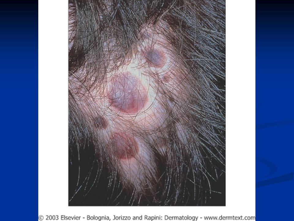 Infantile myofibromatosis aka congenital generalized fibromatosis: multiple firm violaceous papulonodules on the scalp