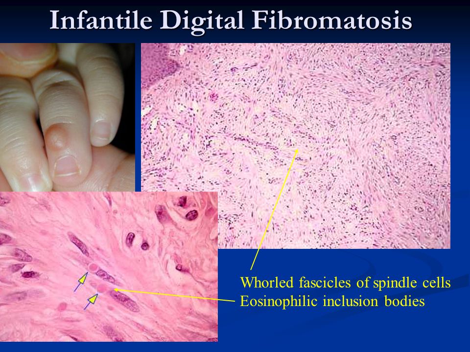 Infantile Digital Fibromatosis