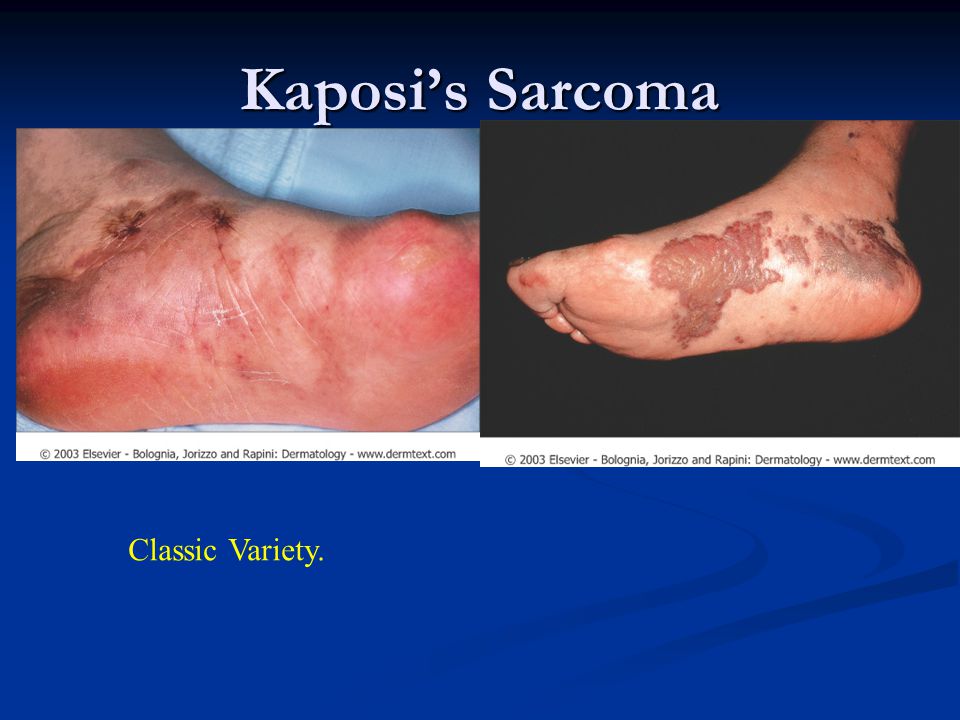 Kaposi’s Sarcoma Classic Variety.