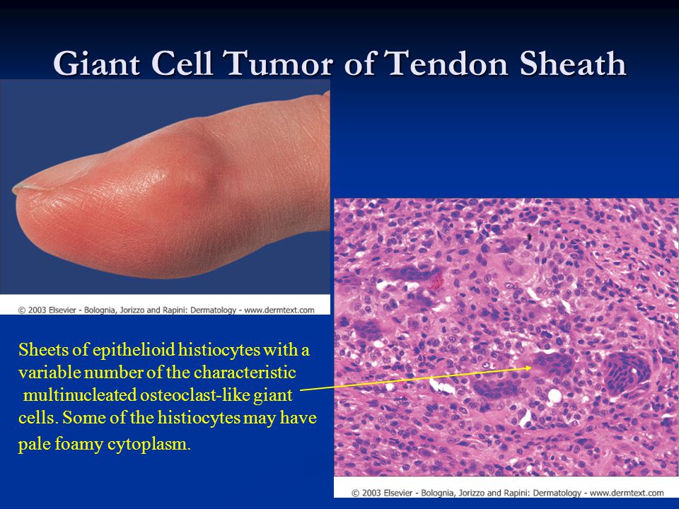 Giant Cell Tumor of Tendon Sheath