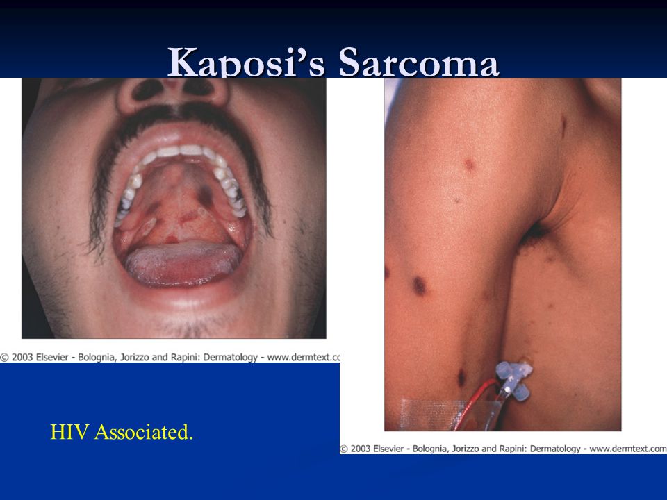 Kaposi’s Sarcoma HIV Associated.