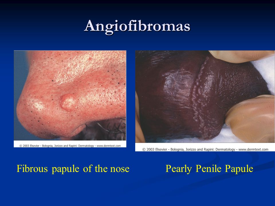 Angiofibromas Fibrous papule of the nose Pearly Penile Papule