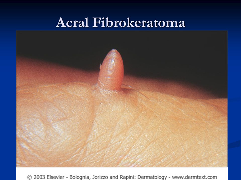Acral Fibrokeratoma