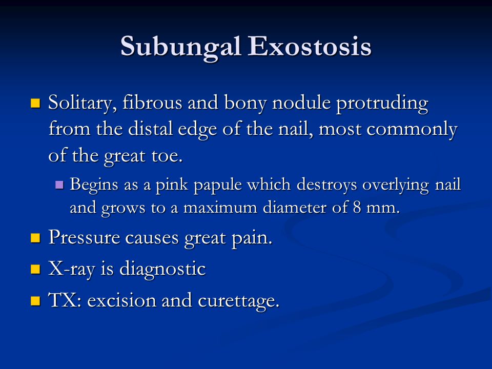 Subungal Exostosis Solitary, fibrous and bony nodule protruding from the distal edge of the nail, most commonly of the great toe.