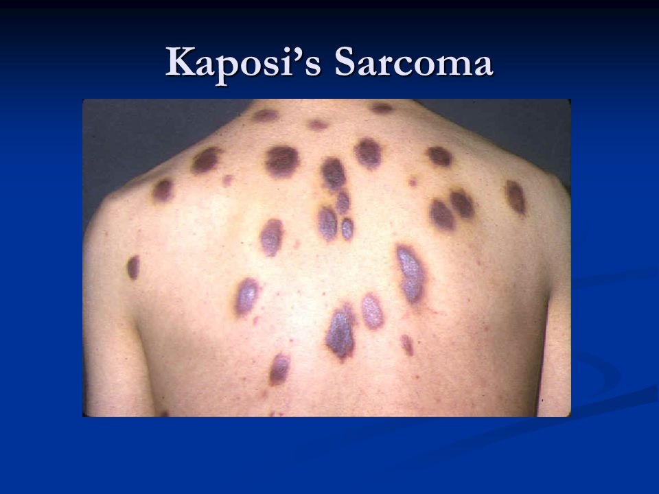 Kaposi’s Sarcoma