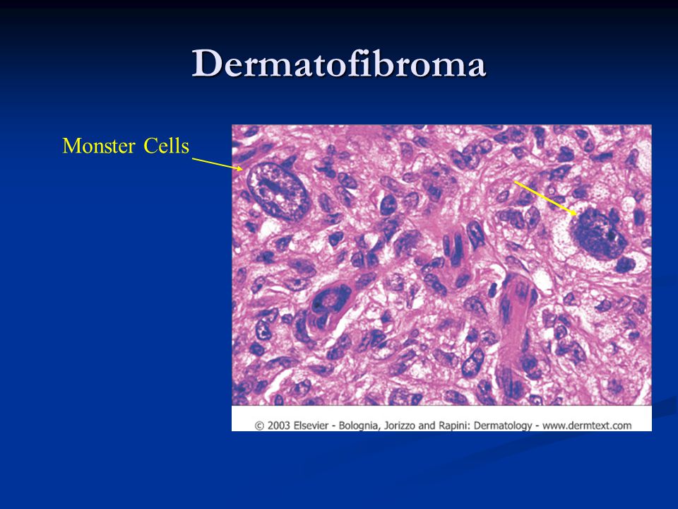 Dermatofibroma Monster Cells