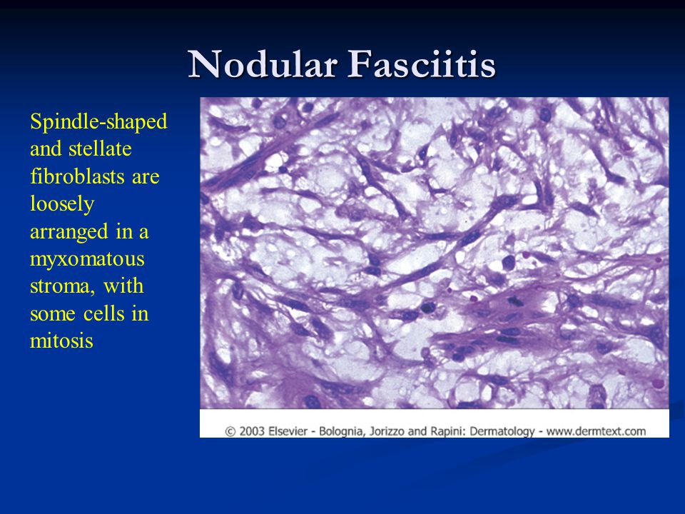 Nodular Fasciitis Spindle-shaped and stellate fibroblasts are loosely arranged in a myxomatous stroma, with some cells in mitosis.