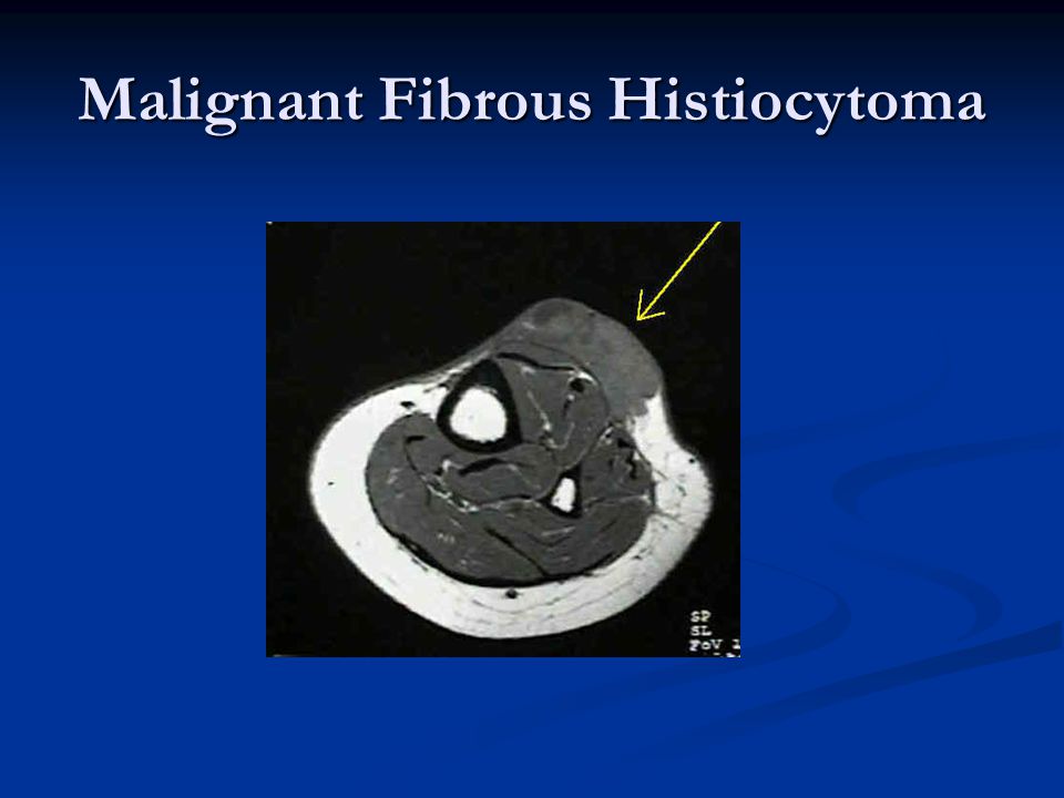 Malignant Fibrous Histiocytoma