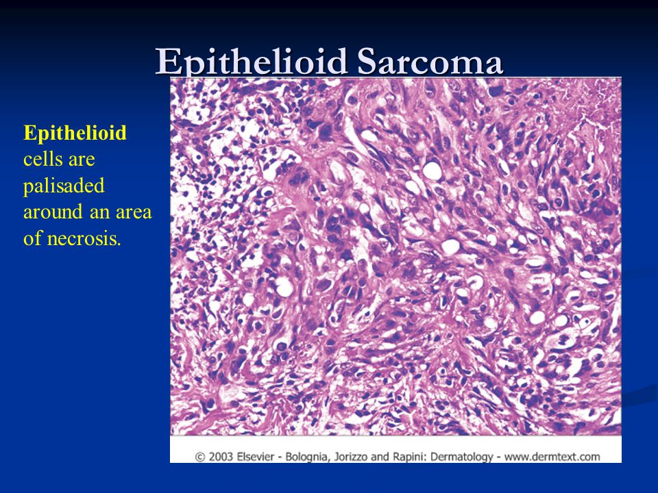 Epithelioid Sarcoma Epithelioid cells are palisaded around an area of necrosis.
